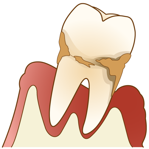 お口の中だけではない、歯周病の影響！