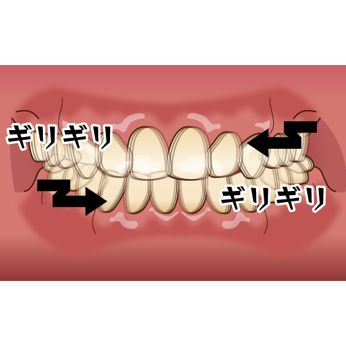 人間の噛む力