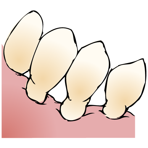歯ぐきが・・・下がる？？