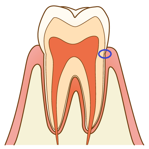 歯の根元のむし歯は進行が早い？